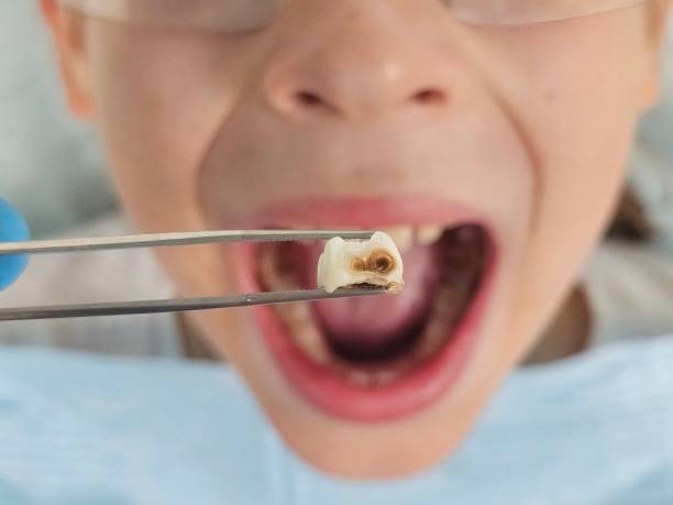 Best Emergency Dentist for Lost Fillings or Crowns in Ben Avon, SC